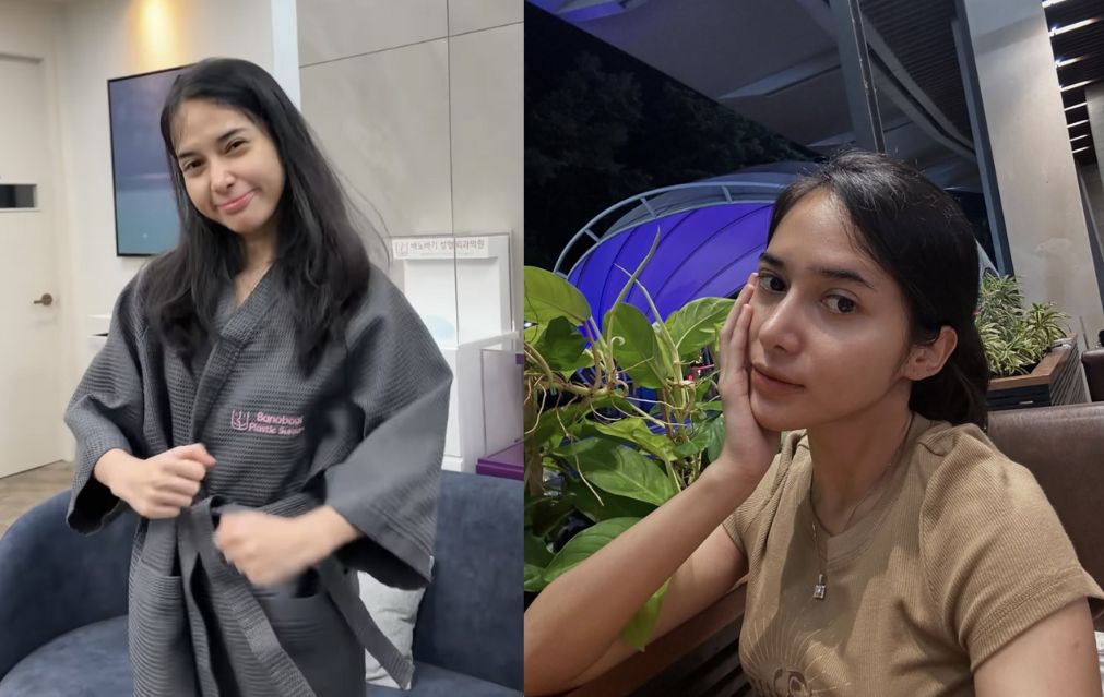 TikToker Dilan Janiyar dan Perjalanannya Jalani Operasi Plastik Forehead Surgery hingga Kontur Wajah